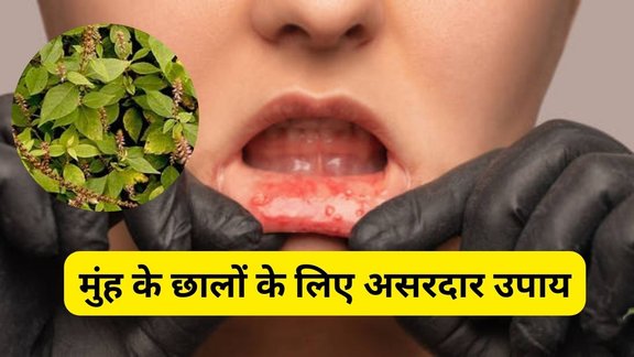 Mouth Ulcer Remedies, muh ke chhale ka ilaj, chirchita ke patte ke fayde, muh ke chhale turant kaise theek kare, muh ke chhale gharelu upay, mouth ulcers home remedy hindi, chirchita patte ayurvedic fayde, danton ka peelapan ka ilaj, oral health tips hindi, chirchita ke patte se munh ke chhale, chirchita se dant safed kaise kare, mouth ulcer causes hindi, ayurvedic remedy for mouth ulcers, natural teeth whitening hindi, ayurvedic tips for oral care, how to heal mouth ulcers quickly, what deficiency causes mouth ulcers, how to cure mouth ulcer in one day, how to cure mouth ulcers fast naturally
