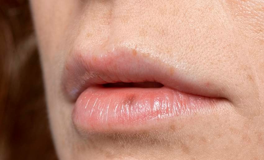 Vitamin for chapped lips