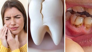 Home and Natural Remedies for Toothache Pain | Yellow teeth bad breath and gum bleeding | how to stop tooth pain fast