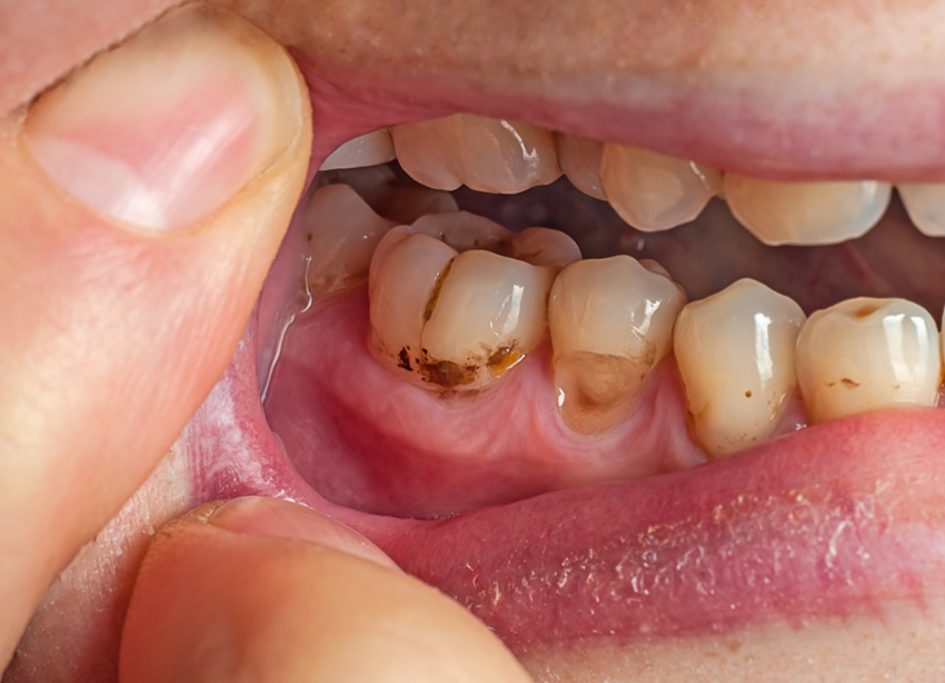 dentist tips for clean teeth