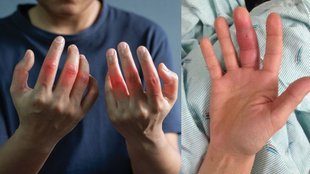 Fingers swelling in winter, Swollen fingers causes, Winter finger swelling, Oedema in winter, Cold weather swelling, Raynaud’s phenomenon symptoms, Arthritis swelling in fingers,