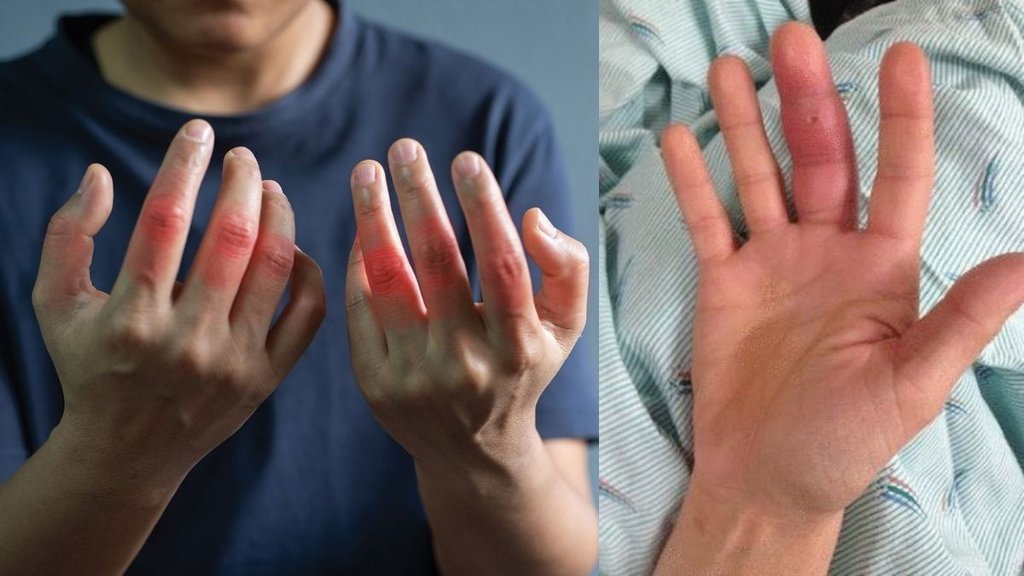 Fingers swelling in winter, Swollen fingers causes, Winter finger swelling, Oedema in winter, Cold weather swelling, Raynaud’s phenomenon symptoms, Arthritis swelling in fingers,