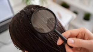 remove dandruff home remedies, dandruff home remedies, dandruff se chutkara pane ke upay