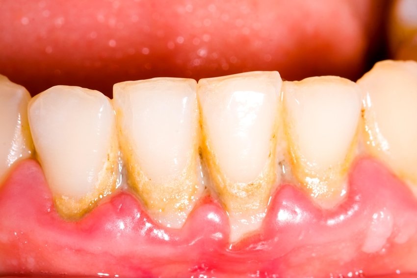 tartar buildup on teeth