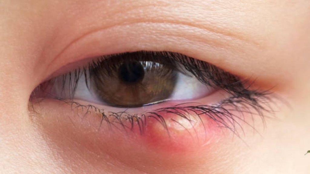 eye-stye-problem-treatment-in-hindi-aankhon-me-bilni-guheri-se-rahat-upay