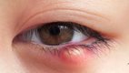 eye-stye-problem-treatment-in-hindi-aankhon-me-bilni-guheri-se-rahat-upay