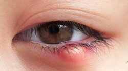 आंखों में बार-बार हो जाती है बिलनी या गुहेरी? इन असरदार तरीकों से पाएं जल्दी आराम, जानें उपाय