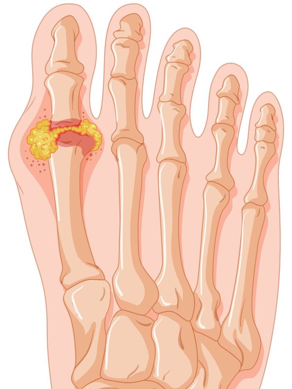 Uric acid symptoms and treatment