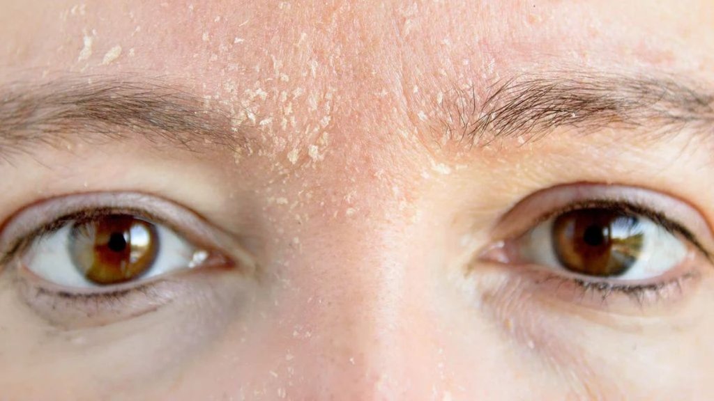 eyebrow dandruff, get rid of eyebrow dandruff, Eyebrow eczema treatment