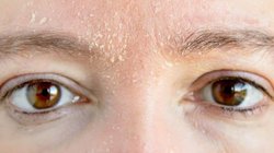 आइब्रो की डैंड्रफ से कैसे पाएं छुटकारा? एलोवेरा के साथ इस तेल का करें इस्तेमाल