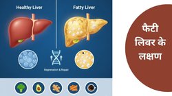 Fatty Liver Symptoms: सावधान! जिसे आप मामूली अपसेट स्टमक समझ रहे हैं, वो फैटी लिवर का संकेत तो नहीं? जानें ये 6 साइलेंट सिम्पटम