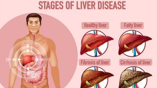 Fatty liver symptoms in Hindi, Early signs of liver damage, Locker pain vs gas pain, Fatty liver recovery tips, Fatty Liver vs Normal Stomach Issue,