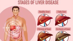 Fatty Liver Symptoms: फैटी लिवर के बॉडी में दिखते हैं ये 6 साइलेंट सिम्पटम, पेट में होने वाले इन बदलाव से तुरंत करें लक्षणों की पहचान
