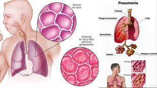 Pneumonia symptoms in winter, Why pneumonia risk increases in cold weather, Early signs of pneumonia in adults, निमोनिया के लक्षण और बचाव,