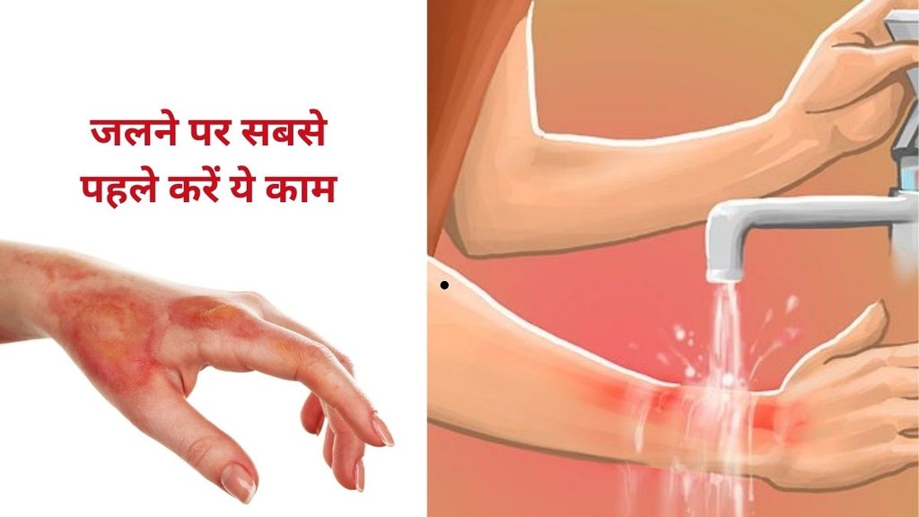 Dangerous burn remedies, Toothpaste on burns side effects, First aid for burns at home, जले पर क्या न लगाएं, जले का सही उपचार,burns, burn treatment,