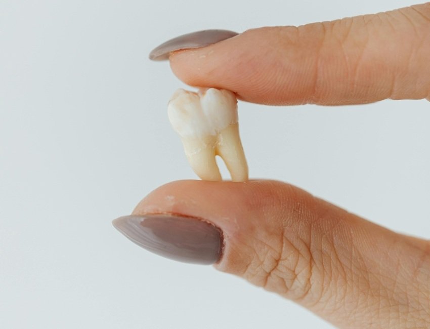 stem cells in wisdom teeth