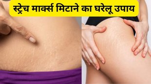 Best treatment for stretch marks | Pregnancy ke Stretch marks kaise hataye gharelu upay | How to remove stretch marks fast on thighs and hips