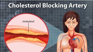 How to control LDL cholesterol without medicine, CHOLESTROL CONTROL, cholestrol control tips, LDL cholesterol normal range by age,Natural ways to lower bad cholesterol,