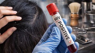 Dandruff and HIV, Seborrheic dermatitis HIV, Is dandruff a sign of HIV, Ea rly signs of HIV, HIV skin symptoms, Can you get HIV from barber, Seborrheic dermatitis causes, Viral health claim fact check,डैंड्रफ और HIV, सेबोरिक डर्मेटाइटिस क्या है, क्या डैंड्रफ HIV का संकेत है, HIV के शुरुआती लक्षण, स्कैल्प की समस्या और HIV