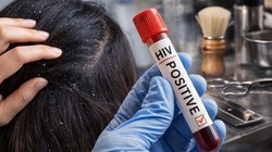 Seborrheic Dermatitis: क्या डैंड्रफ गंभीर बीमारियों का शुरुआती संकेत है? एक्सपर्ट से समझें इसके पीछे का विज्ञान