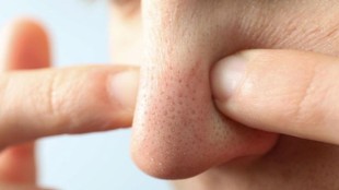 nose blackheads , blackheads on your nose