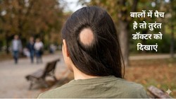 क्या आपके स्कैल्प और उसके आस-पास से राउंड शेप में बाल उढ़ रहे हैं? Alopecia Areata के हो सकते हैं ये लक्षण, डर्माटॉलोजिस्ट से जानिए सारी जानकारी