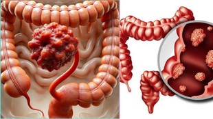 Vitamin D and Cancer, Colorectal Cancer Prevention, विटामिन डी और कैंसर,कोलोरेक्टल कैंसर से बचाव, Vitamin D Benefits for Heart and Gut,विटामिन डी के फायदे