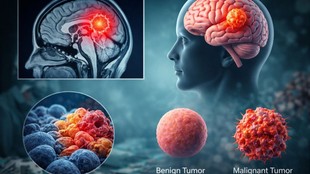 can a person live with a brain tumor,brain tumor ka ilaj, brain tumor, What causes brain tumors, What were your first signs of a brain tumor,