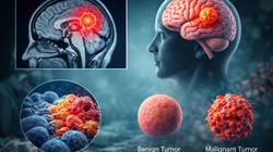किन लोगों को है ब्रेन ट्यूमर का सबसे ज्यादा खतरा? एक्सपर्ट ने बताए 6 वार्निंग सिग्नल जिन्हें जानना है जरूरी