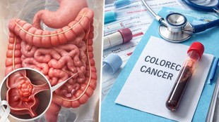 healthy diet for colon health, colonoscopy screening age, obesity and cancer risk, smoking and colorectal cancer, alcohol cancer risk
