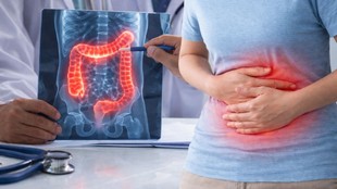 Inflammatory Bowel Disease, What is Inflammatory Bowel Disease, Inflammatory Bowel Disease Cause, Inflammatory Bowel Disease Symptoms,