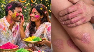 Psoriasis Holi precautions, Psoriasis care during Holi,Psoriasis skin care tips, Chemical colors side effects on psoriasis, सोरायसिस में डाइट क्या रखें, नारियल तेल और सोरायसिस, Herbal Holi colors for sensitive skin