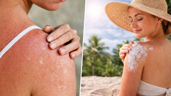 sunburn-prevention tips | Garmiyon-me-dhup-se-bachne-ke-tarike | skin-care sunburn-prevention tips-hindi