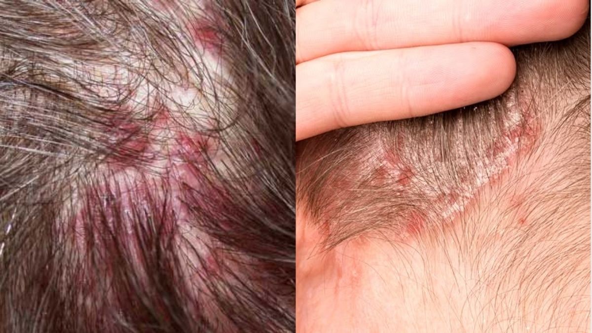 Scalp Folliculitis,Prevention Tips,Dermatologist Advice,Sweat & Bacteria,scalp acne causes folliculitis symptoms, scalp infection treatment Scalp Folliculitis,Prevention Tips,Dermatologist Advice,Sweat & Bacteria,scalp acne causes folliculitis symptoms, scalp infection treatment
