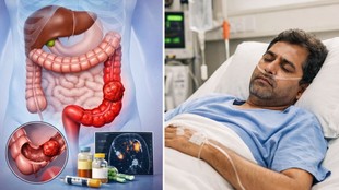 Sigmoid colon cancer, liver metastasis, stomach discomfort, early detection, silent symptoms, gastrointestinal health, oncological screening,