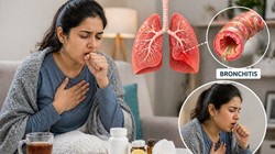 हल्का बुखार, लगातार खांसी, खांसी के साथ बलगम ब्रोंकाइटिस के हो सकते हैं लक्षण, डॉक्टर से जानिए बीमारी का कारण, प्रकार और बचाव