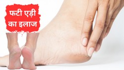 गर्मी में भी फट जाती हैं एड़ियां, इस तरह मुलायम बनाने और दरारें भरने में मिलेगी मदद, बरतें ये सावधानी
