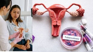 genital tuberculosis, infertility symptoms,genital tuberculosis symptoms, TB and infertility in women, IVF failure causes India, blocked fallopian tubes TB,