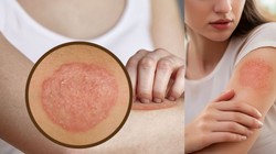 Skin Care Tips: बदलते मौसम में दाद और खुजली से हैं परेशान? आयुर्वेदिक एक्सपर्ट से जानें राहत पाने के सुरक्षित घरेलू उपाय
