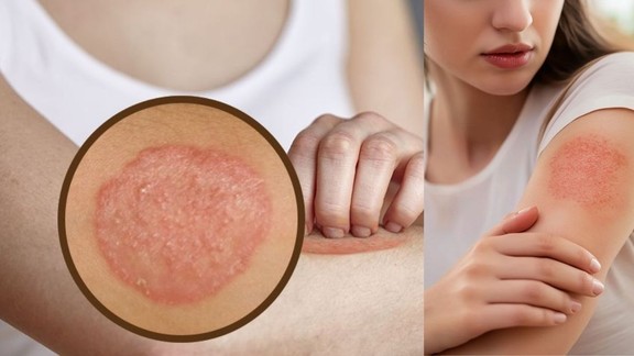 Ayurvedic remedies for Ringworm, Skin itching in changing weather, Daad khujli ka gharelu upar, Ayurvedic skin care tips,