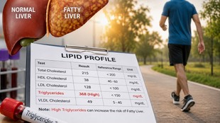 Fatty liver diet, Lower triglycerides, Reverse fatty liver, Triglycerides control, Fatty liver lifestyle, Weight loss, High triglycerides,