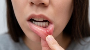 mouth cancer symptoms in hindi, long lasting mouth ulcers reasons, early signs of oral cancer mouth ulcers, oncologist advice on mouth ulcers,