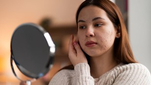 pigmentation-signs-causes-symptoms | Chehre ke kale dhabbe | Face par kale dhabbe