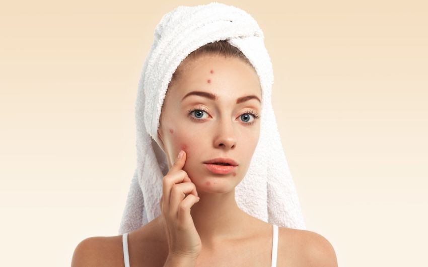 monsoon acne