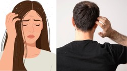 मानसून में रूसी और खुजली से हैं परेशान, एक्सपर्ट्स से जानिए वजह और बचाव के तरीके