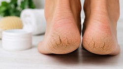 Cracked Heels Warning: क्या क्रीम लगाने के बाद भी नहीं ठीक हो रहीं फटी एड़ियां? एक्सपर्ट्स से जानिए शरीर में किस सीक्रेट न्यूट्रिएंट की है कमी