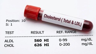Cholesterol, bad cholesterol, FDA approves Lipfendra, Lipfendra, LDL cholesterol, high cholesterol treatment, oral PCSK9 inhibitor, bad cholesterol, cholesterol medication, familial hypercholesterolaemia