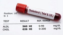 Cholesterol Treatment Revolution: अब बिना सुई-इंजेक्शन के घटेगा बैड कोलेस्ट्रॉल! FDA ने मंजूर की नई दवा Lipfendra, जानिए कैसे करेगी काम