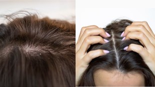 Monsoon dandruff | scalp care | dandruff remedies