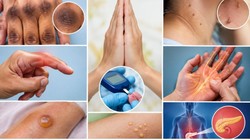हाथों में दिखने वाले ये 5 बदलाव हो सकते हैं High Blood Sugar का इशारा, एक्सपर्ट से जानिए इसके लक्षण और बचाव